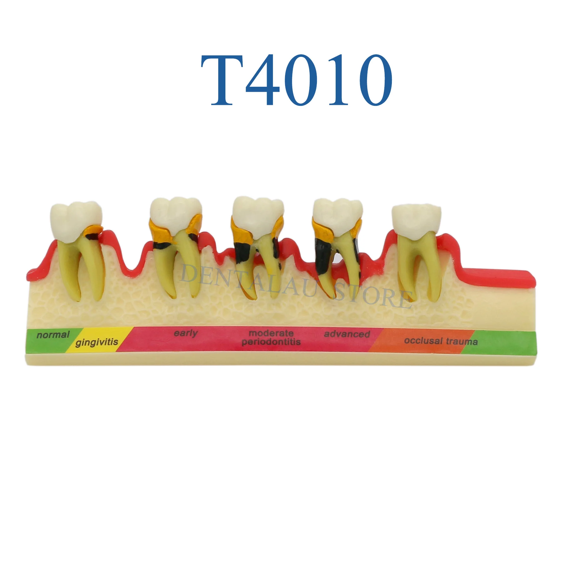 Стоматологическая модель T4010 Модель заболеваний пародонта Модель зубов Typodont Пародонтология (СОГЛАСНО)